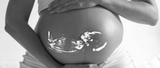Многоводие при беременности причины и последствия для ребенка