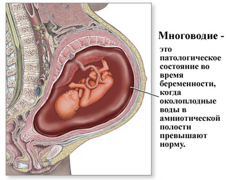 Многоводие при беременности причины и последствия для ребенка